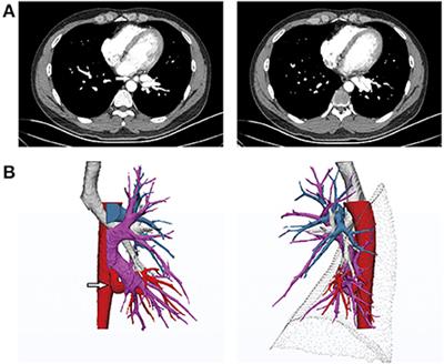 Frontiers Anomalous systemic arterial supply to the left lower